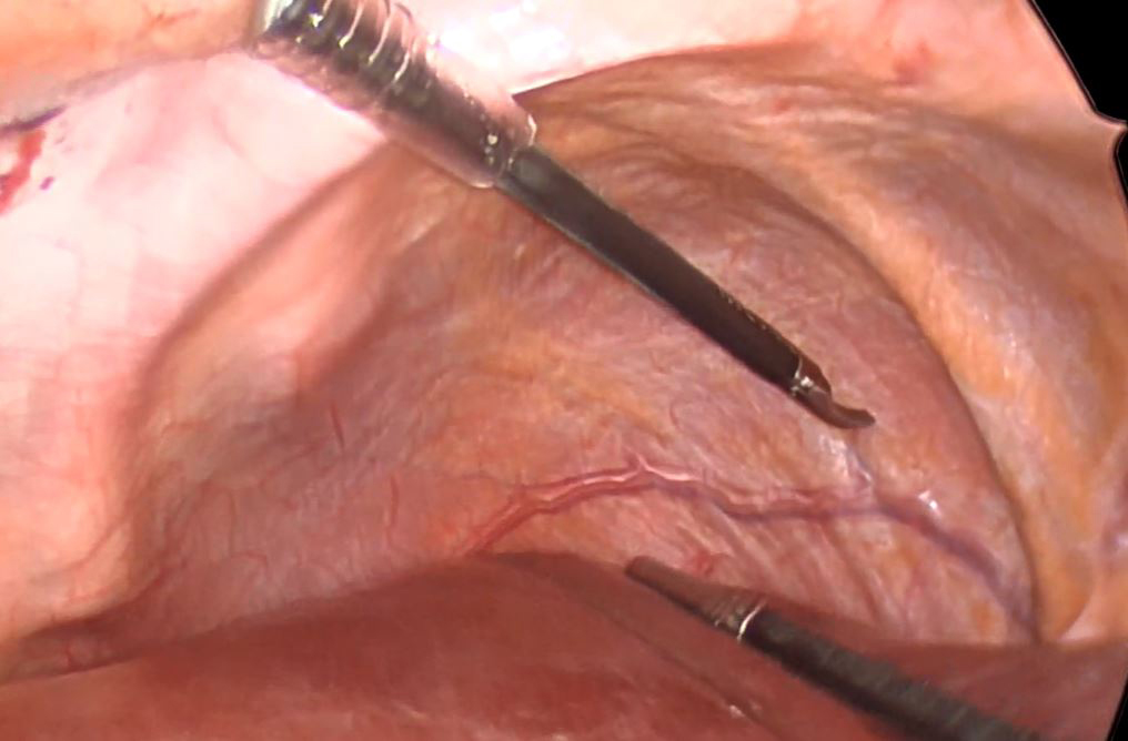 closeup of diaphragm surgery